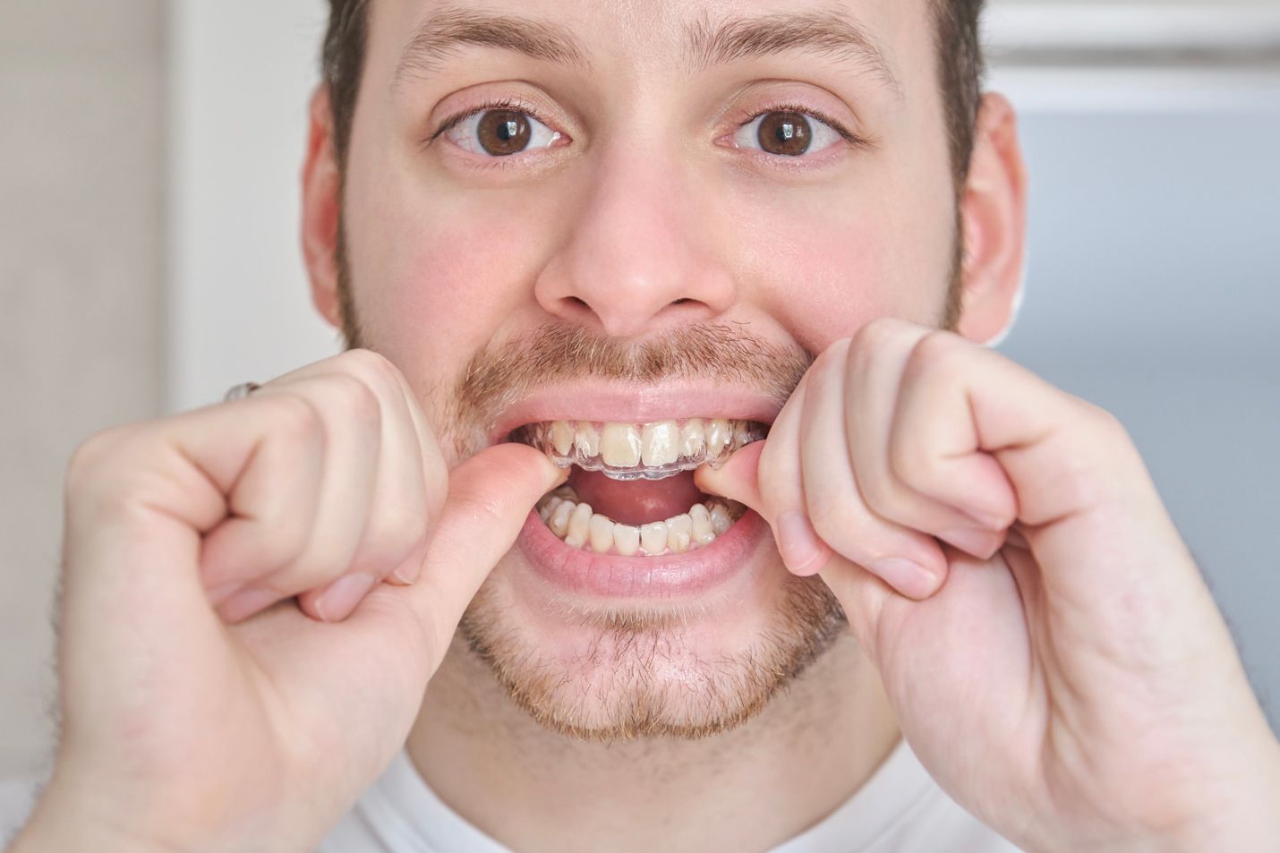 Can Braces Cause Gum Disease? Here’s What You Should Know