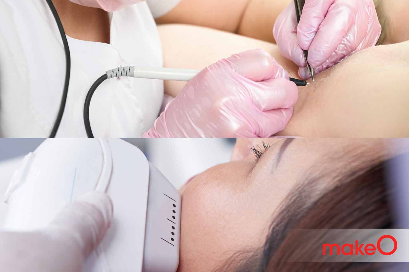 Electrolysis Vs Laser Hair Removal Which is Better?