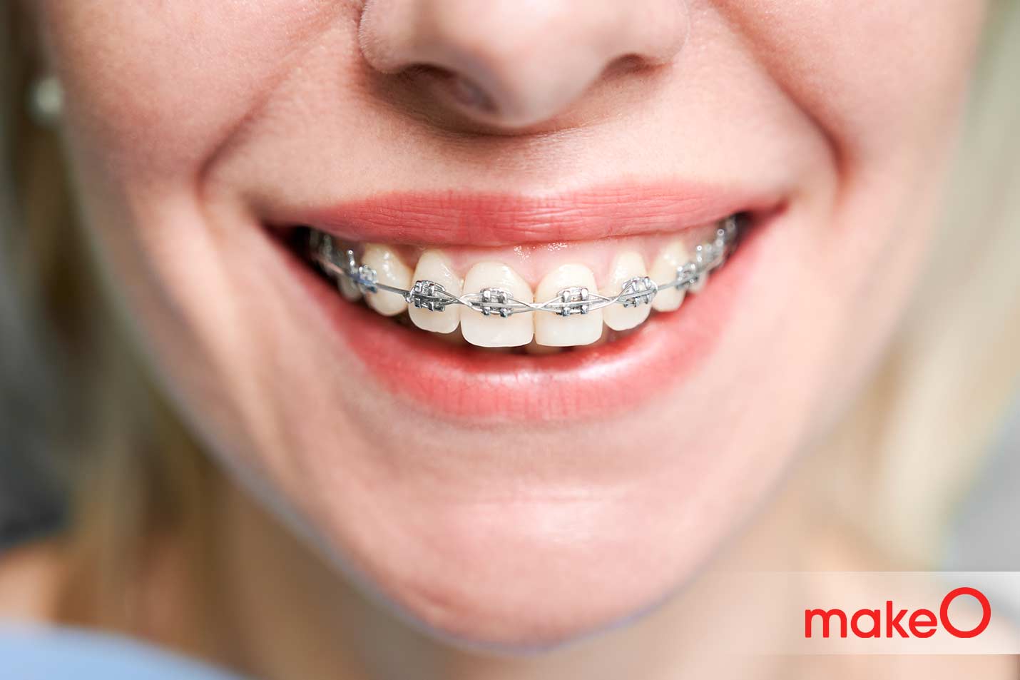 Braces for AdultsNever too late to correct your smile