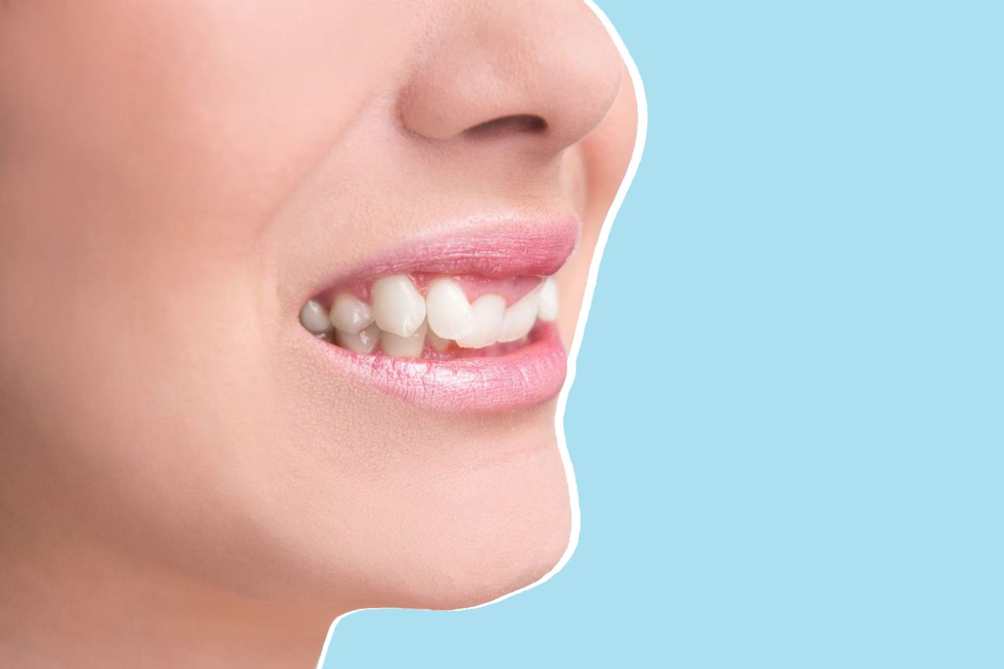 Symptoms And Causes And Solution How To Treat Teeth Shifting Toothsi By Makeo