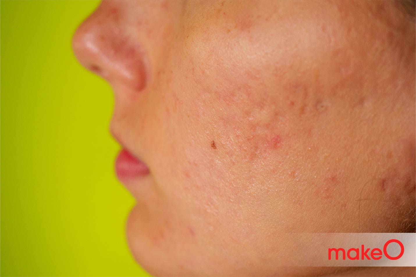 Fighting Redness Caused by Acne Know About Acne Inflammation