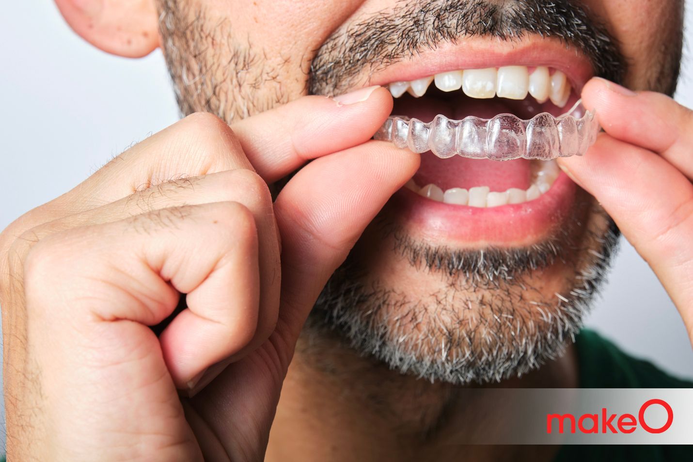 Retainers What are the Benefits of Wearing Retainers?