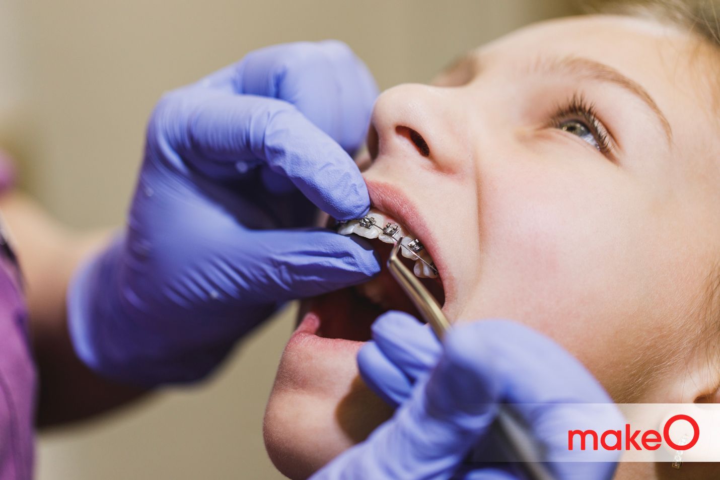 What is Orthodontic Headgear? Types, Cost and Uses