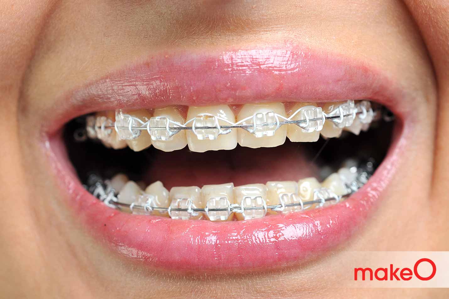 Keep your Ceramic braces Clean and Intact with these secret tips, image size:1430x953