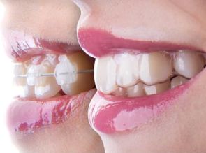 Braces: Types for Teeth, Oral Care & Prices at Toothsi by MakeO