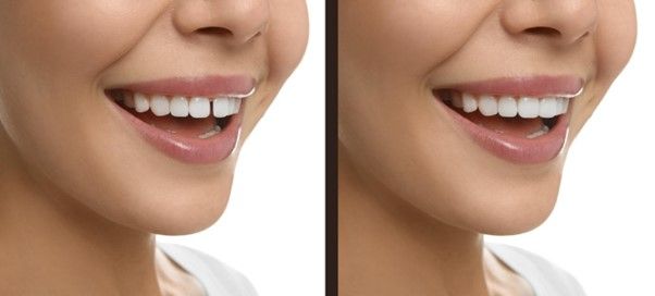 Diastema: Causes & How to Treat