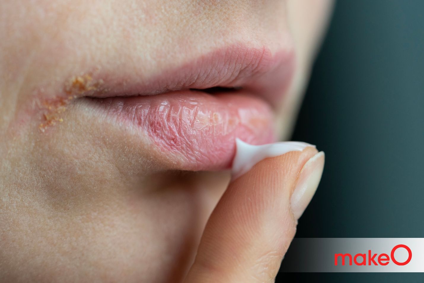 How to Treat Dry Mouth Effective Home Remedies and Causes Explained