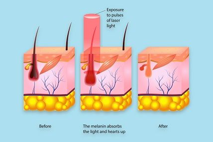 how laser hair removal work.jpg
