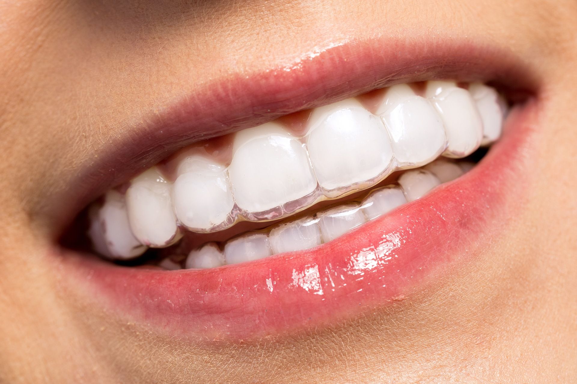 teeth whitening maintenance