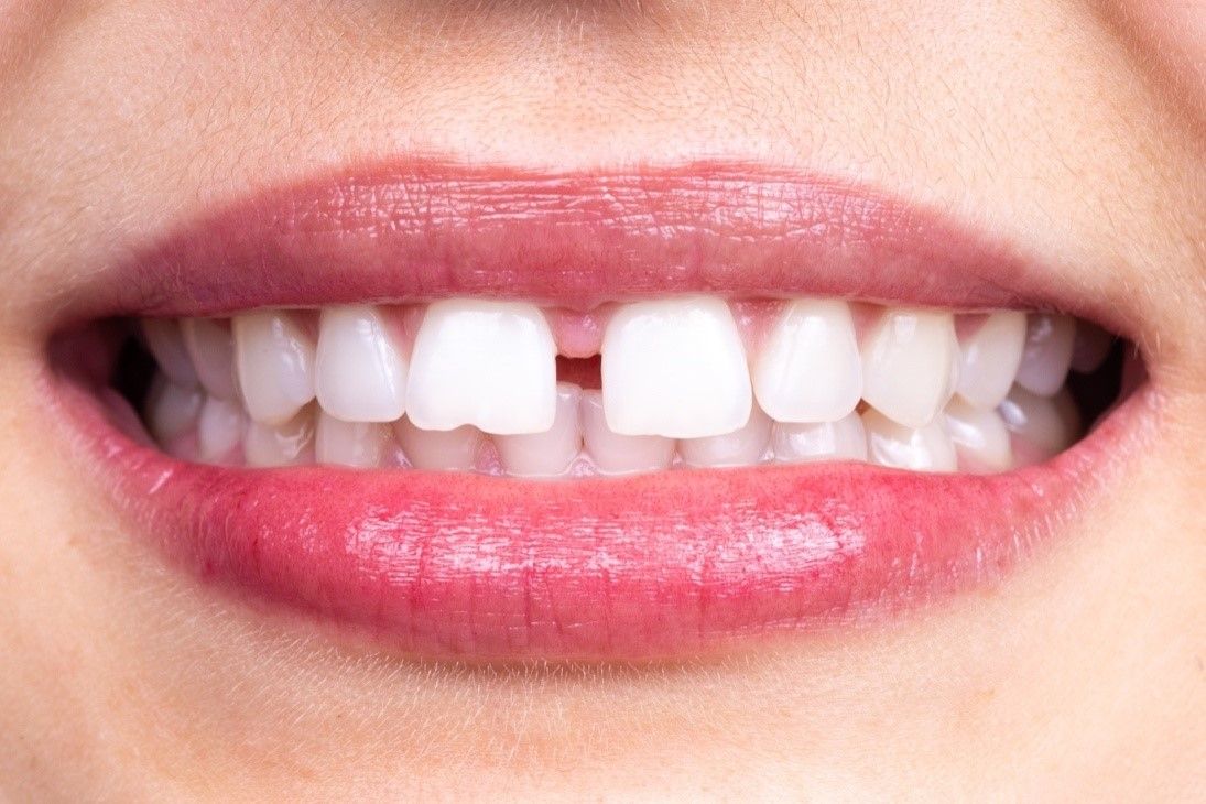 Can clear aligners fix an overbite? - SmilePath NZ