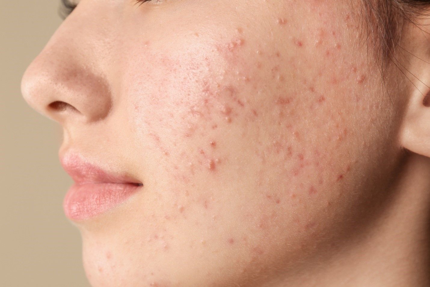 Complete Guide on Face Acne - Causes, Pimple Treatments | makeO skinnsi