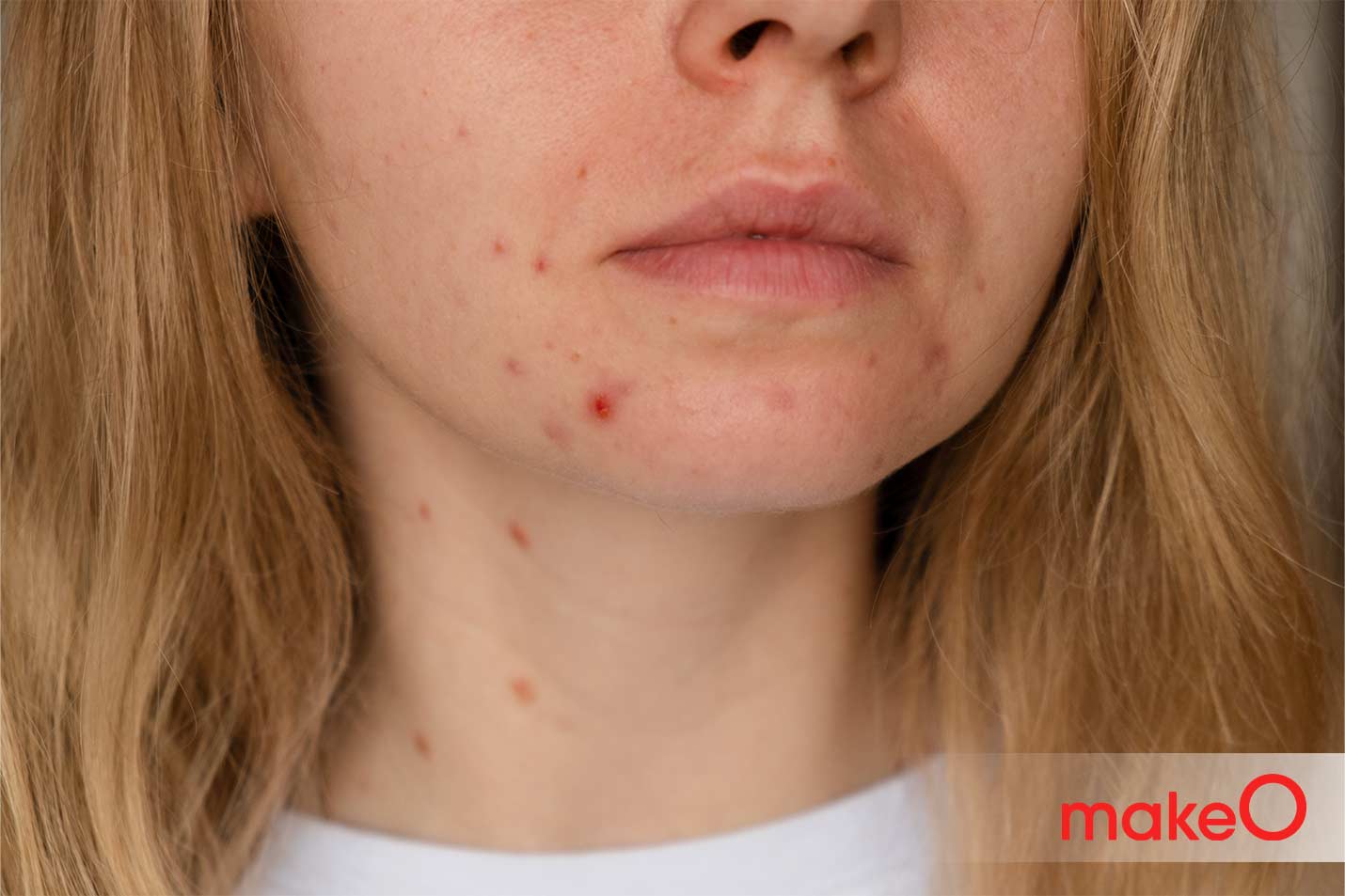 Pimples Due to Heat? Here’s How Weather Affects Acne